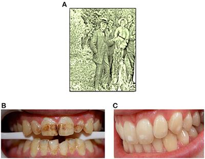 Frontiers Revisiting Fluoride In The Twenty First Century Safety And